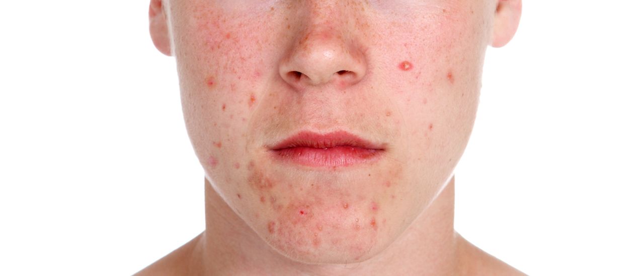Adult acne – what could be causing your skin woes?