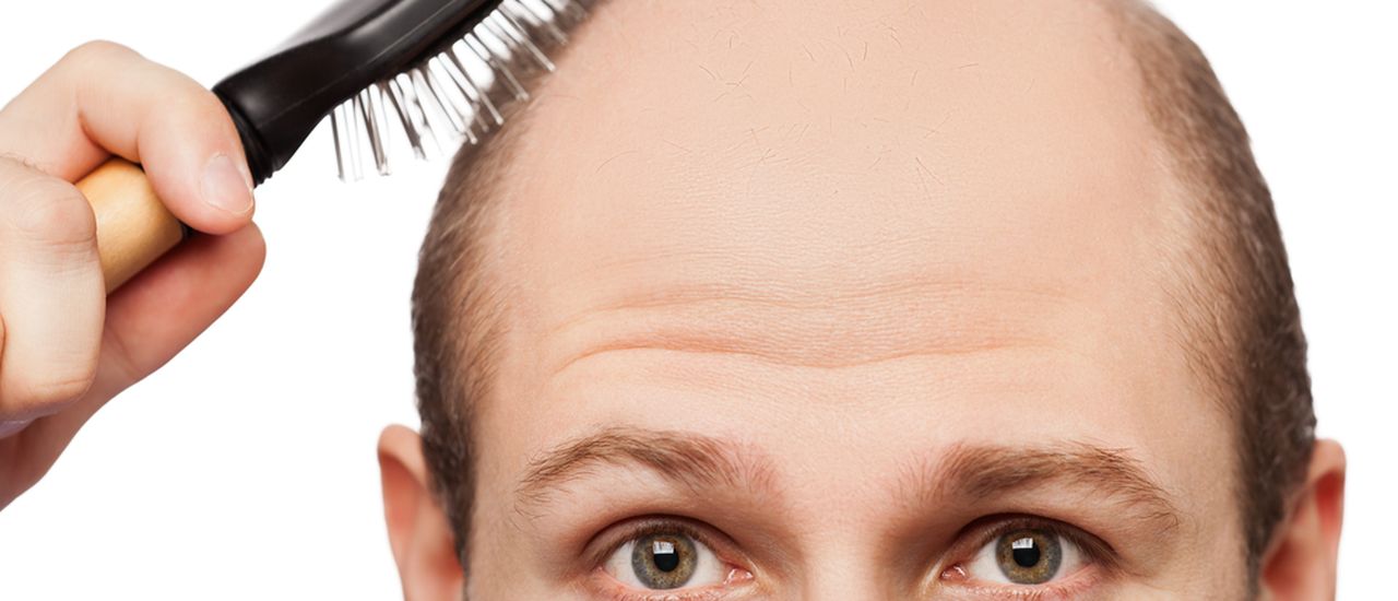 What can you do about male hair loss?