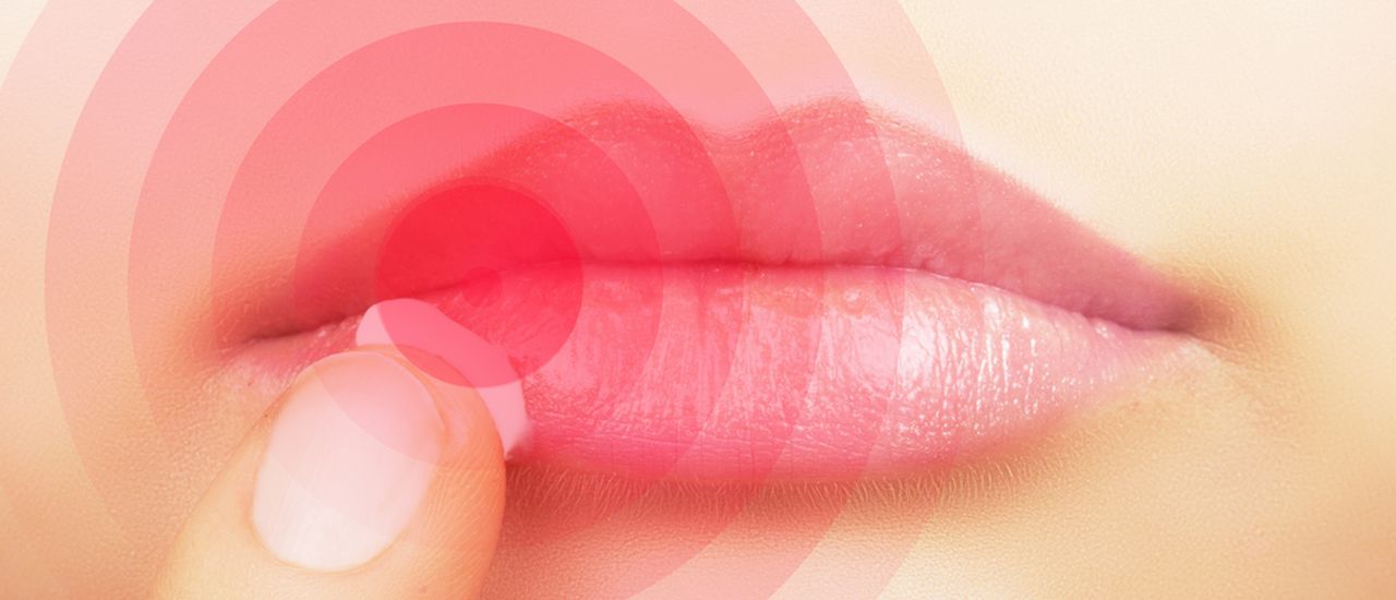 Don’t let cold sores get you down this winter