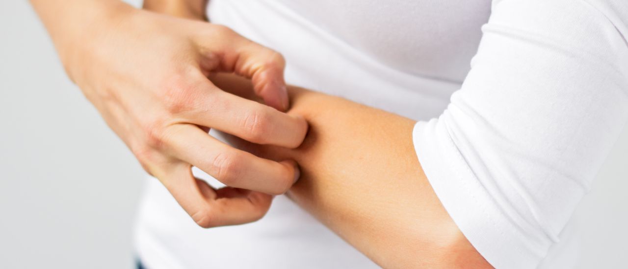 10 things to know about Eczema