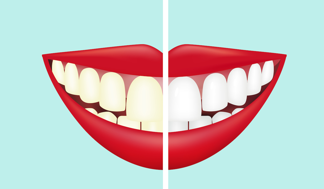 Natural ways to brighter, whiter teeth