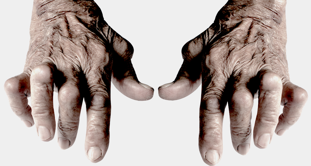 The 3 most common types of arthritis