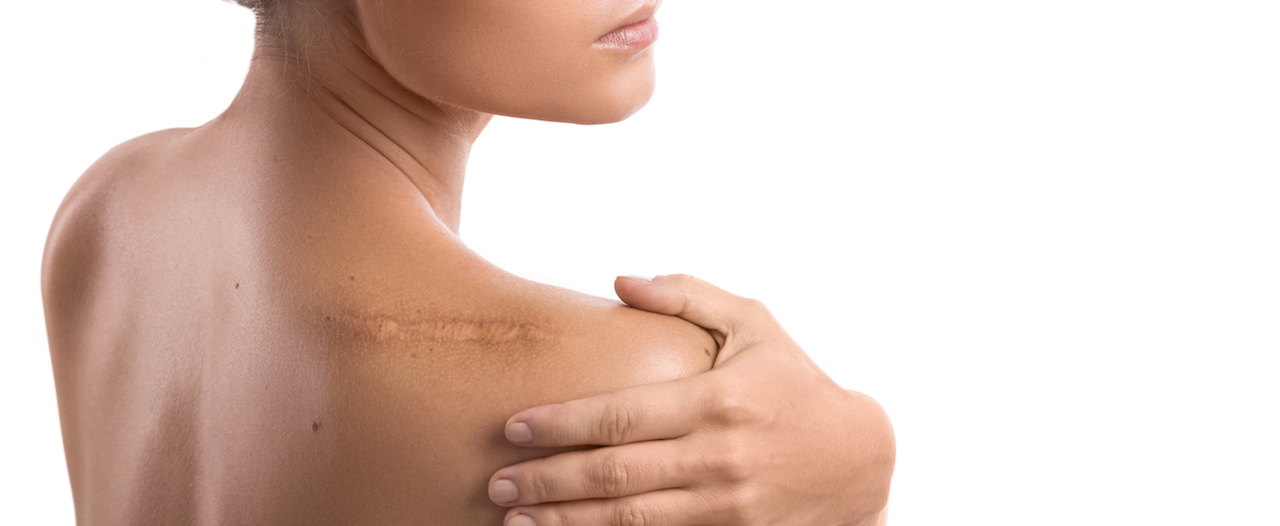 What to do to prevent the worst kind of scars