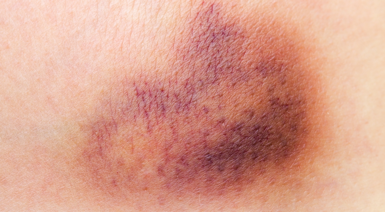 The causes and treatment for constant bruising