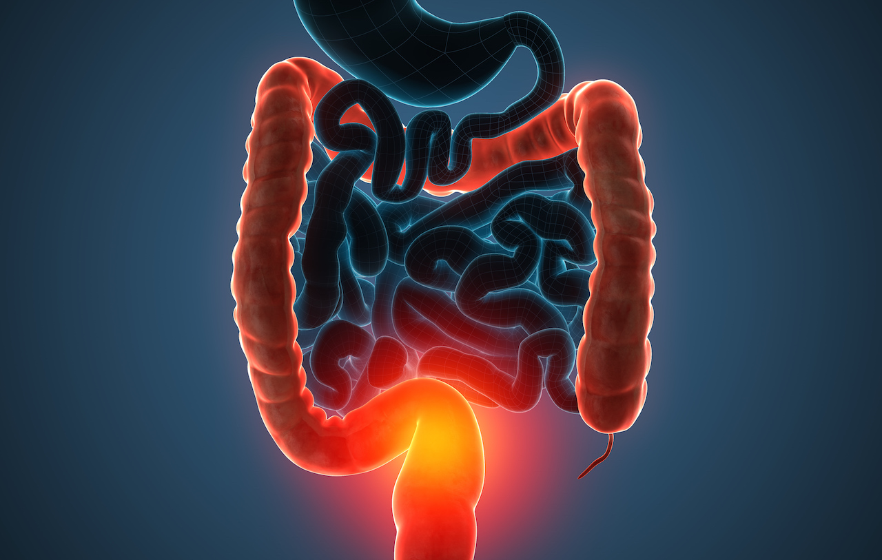The main causes of colon cancer