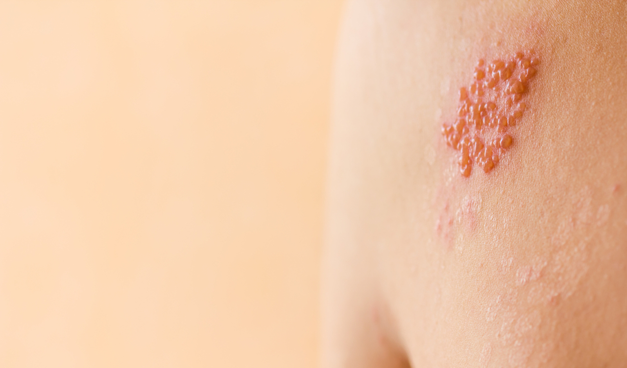 Painful blisters – is it sunburn or shingles?