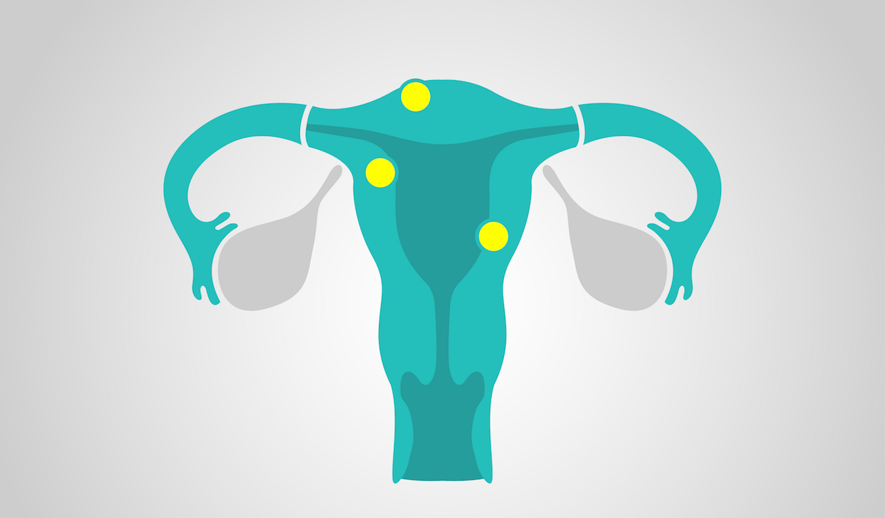 What every woman should know about fibroids
