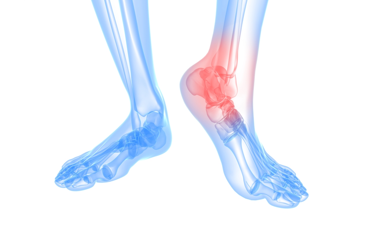 Do I need an X-ray for my ankle sprain?