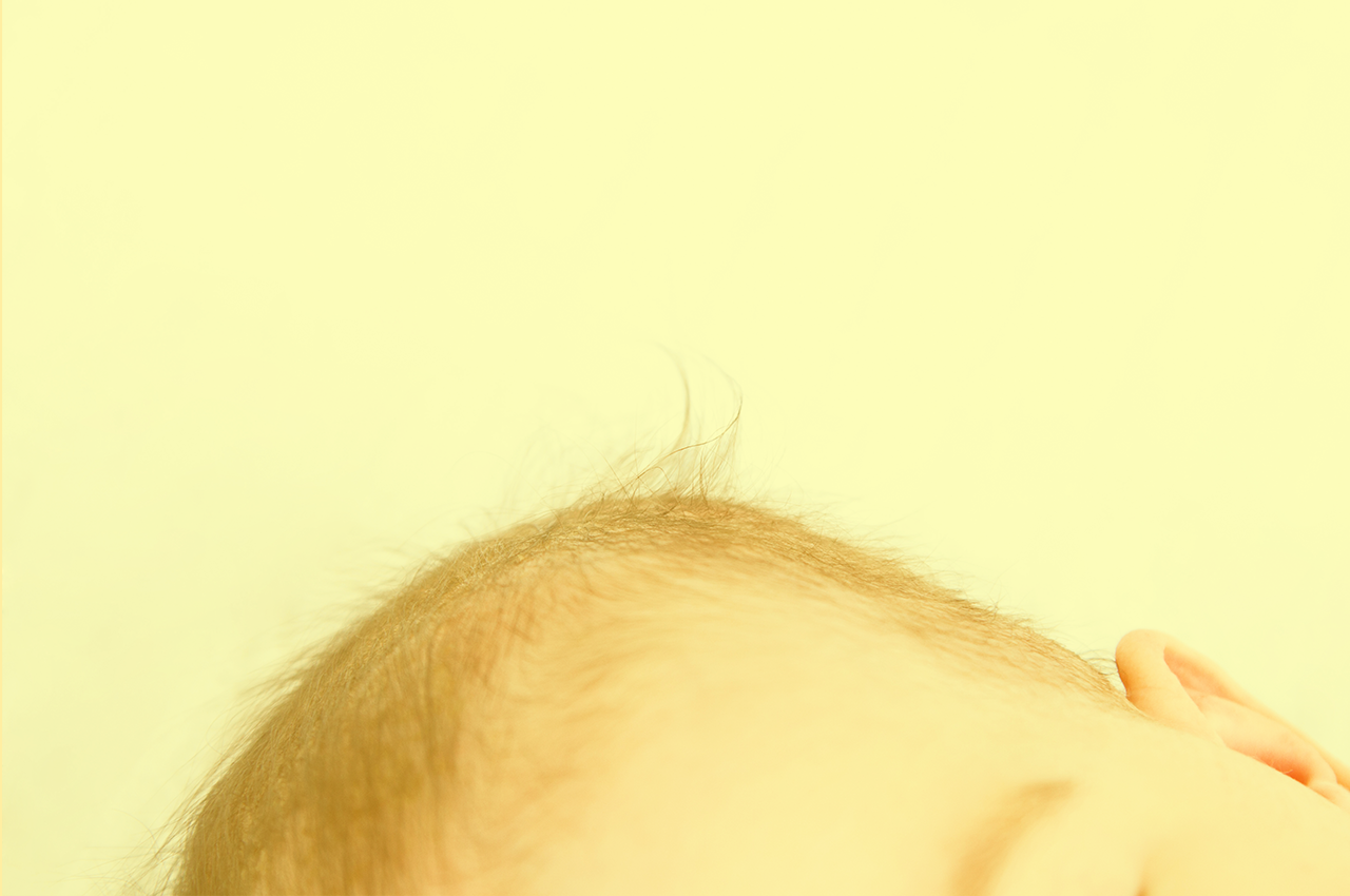 How to treat the yellow rash on your baby’s scalp