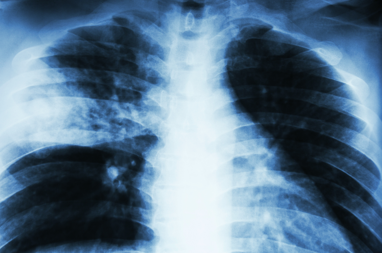 How does your doctor diagnose and treat TB?