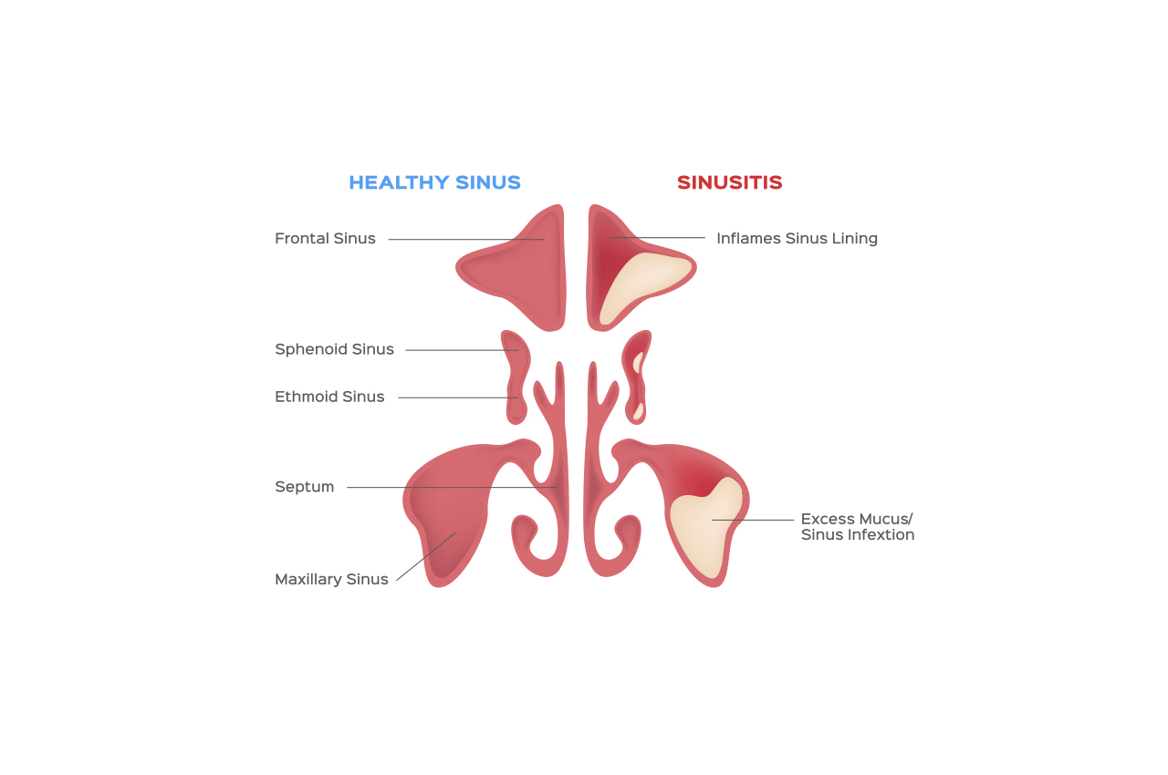 How to treat Chronic Sinusitis  