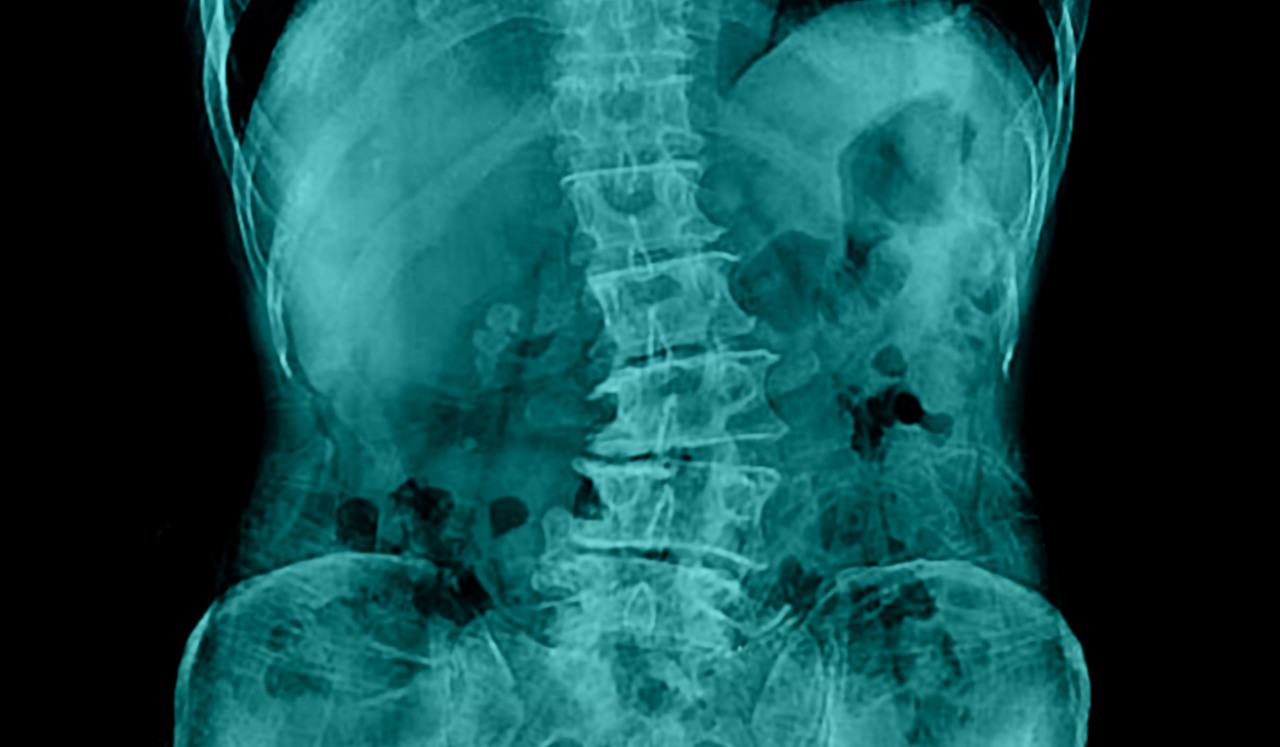 Is your backache due to scoliosis? How to find out.