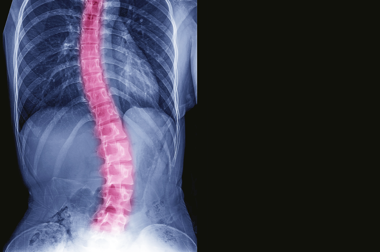 What is scoliosis?